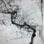 Hospital Unimed Bauru realiza tratamento de aneurisma cerebral com nova tcnica de reconstruo arterial. Foto 2