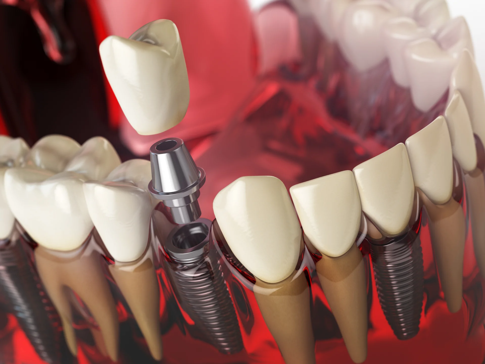 Especializaci�n en Implantolog�a con inmersi�n en Periodoncia y Cirug�a Oral