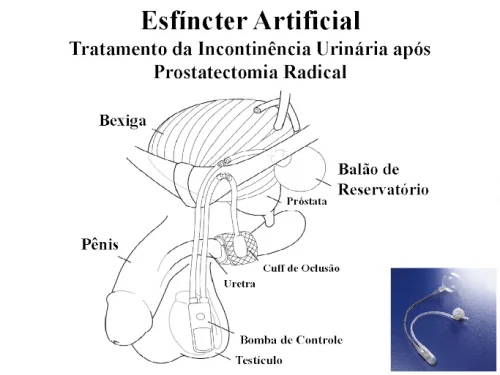 Tratamento da Incontin�ncia Urin�ria em Homens ap�s Prostatectomia Radical por C�ncer de Pr�stata