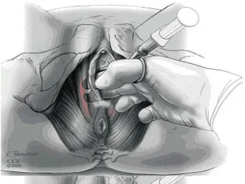 Vaginismo, Dor nas Rela��es Sexuais, Dor na Penetra��o Vaginal