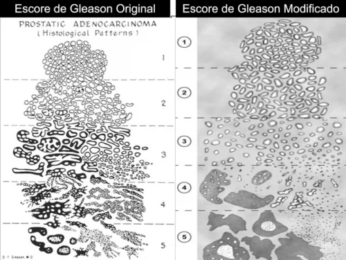 C�ncer de Pr�stata