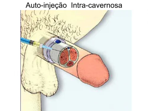 Auto-Inje��o Peniana