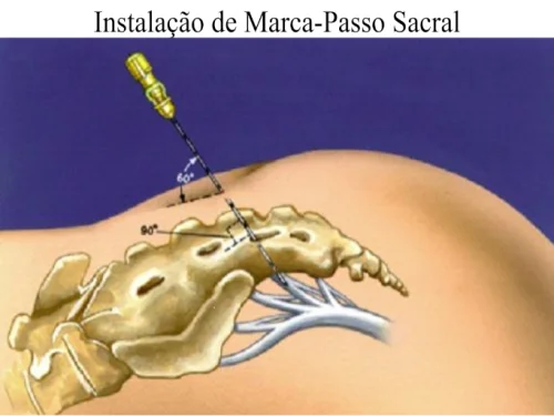 Marca-Passo da Bexiga