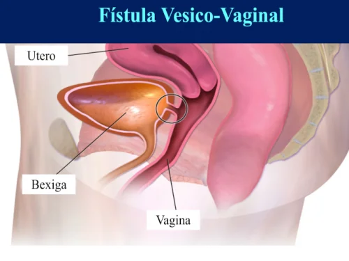 F�stula Urin�ria