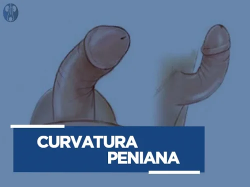 Doen�a de Peyronie ou Curvatura Peniana