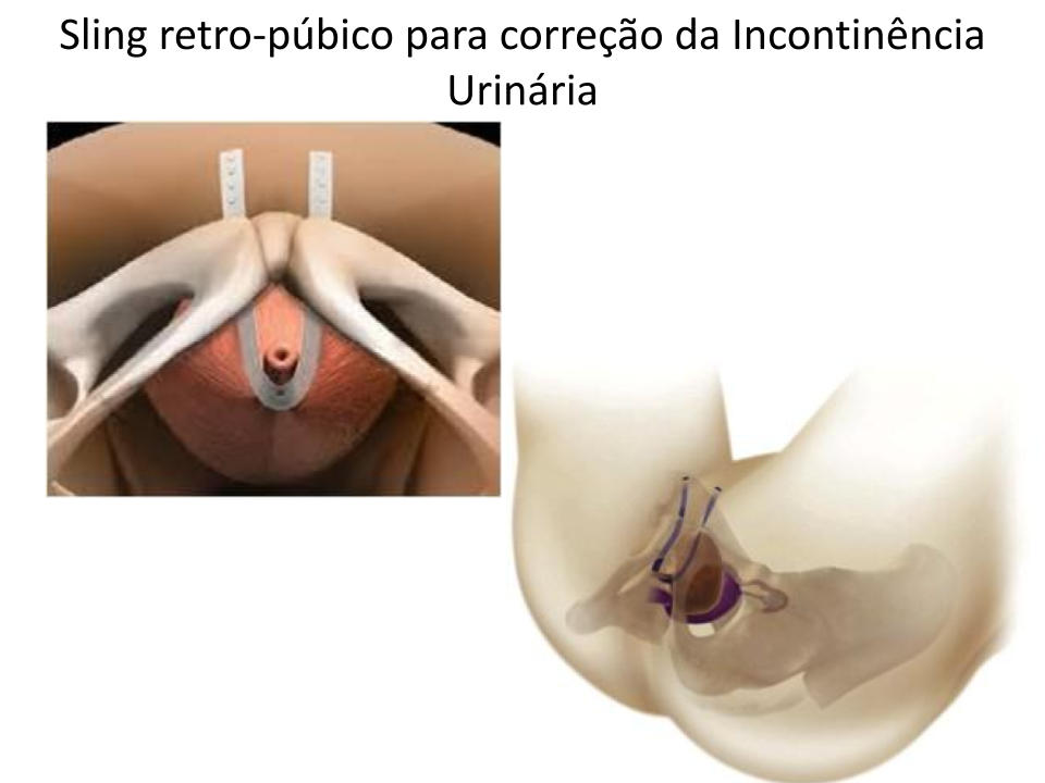 Incontin�ncia Urin�ria Feminina